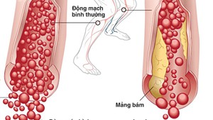 Nguy cơ đoạn chi do tắc động mạch chi dưới