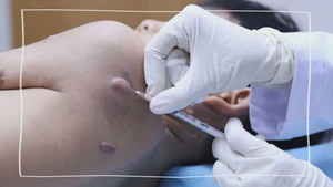 Góc nhìn trưa nay: Sai lầm khi tin vào xóa sẹo 100%