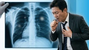 Cảnh báo: Nhiều ca ung thư phổi bắt đầu từ một dấu hiệu có kích thước chưa đến 1cm