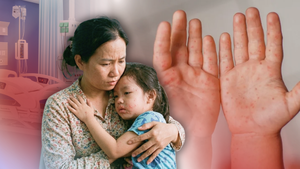 Ca bệnh tay chân miệng nặng đã tăng gấp 5 lần, hướng dẫn cha mẹ cách phòng tránh bệnh cho con