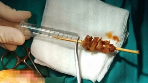 Góc nhìn trưa nay: Bé gái 2,5 tuổi bị que xiên thịt đâm sâu nguy cơ xuyên sọ não