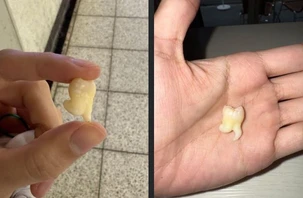 Ảnh vui 3-12: Chiếc răng khôn biết... nhảy chân sáo