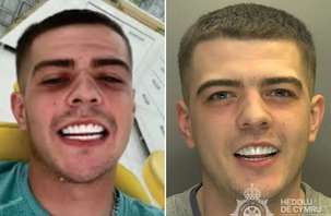 Tên tội phạm bị bắt vì khoe răng 'sáng như quảng cáo'