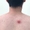 Vết loét tự lành: Dấu hiệu cảnh báo bệnh giang mai?