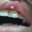 Oral sex tưởng an toàn, cô gái trẻ mắc sùi mào gà ở miệng