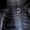 Lấy thành công bông tai trong thực quản bé gái 8 tháng tuổi ở Cà Mau