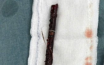 Vietnamese doctors remove 16cm tree branch lodged in 3-year-old girl's abdomen for over 4 months