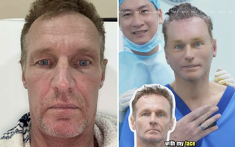 Australian man goes viral after traveling to Vietnam for cosmetic surgery
