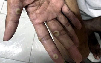 Vietnam’s Dong Nai reports mpox case with unknown source of infection