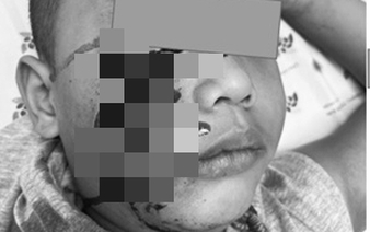 5-year-old Vietnamese boy suffers serious facial injuries after dog attack at home