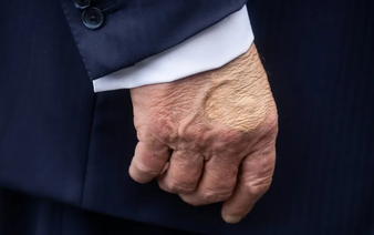 Trump diagnosed with vein issue after leg swelling and hand bruising