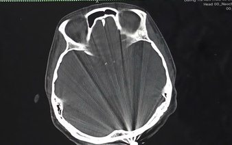 Vietnamese woman survives stray bullet to head while gardening