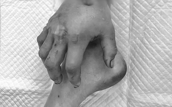 Vietnamese doctors attach severed hand to pregnant woman’s leg to preserve it for future reattachment