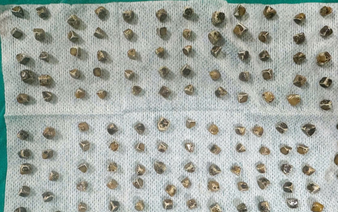 Doctors find 130 gallstones in Vietnamese woman’s gallbladder