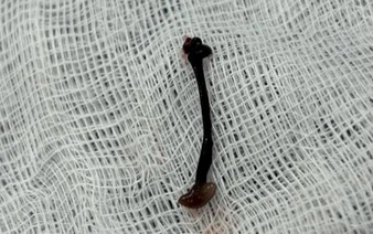 Leech found living in nose of 30-month-old Vietnamese boy