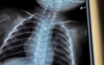 Vietnam hospital saves 2 children who swallowed safety pin, lollipop stick