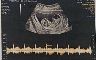 In Vietnam, revealing fetal gender is illegal except in these cases