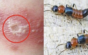 Ever had a burn-like rash appear overnight? These rove beetles in Vietnam may be to blame