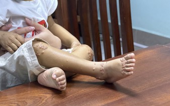Difficult journey of Vietnamese children living with rare Alagille syndrome