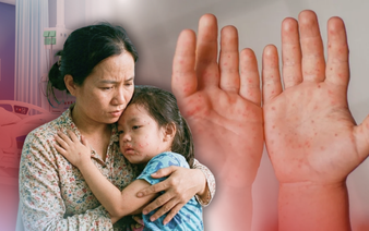 3 common childhood illnesses rise during hot season in Vietnam
