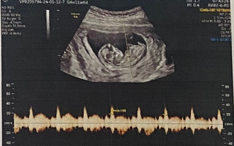 Vietnam to levy higher fine of up to $570 for revealing fetal sex from May 15