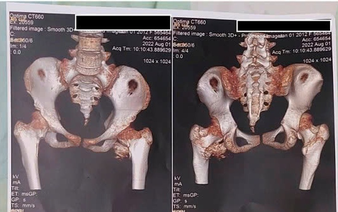 Rare stone man syndrome diagnosed in 12-year-old girl in Ho Chi Minh City