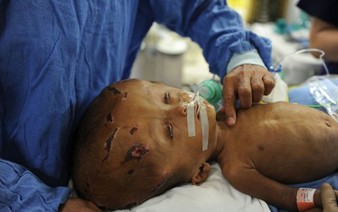 Indian medics reconstruct baby's swollen head