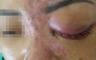 Vietnamese woman left blind in one eye after using injectable filler