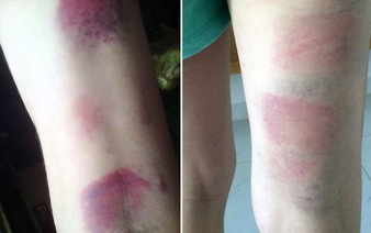 Vietnamese teacher suspended after beating 22 eighth-graders with ruler