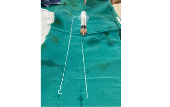 Vietnamese man infested with rare worms