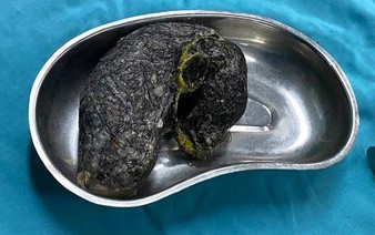 Vietnamese doctors remove 0.5kg of hair from stomach of child with Rapunzel syndrome