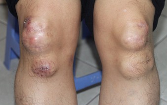 Ho Chi Minh City siblings found with world’s first reported gene mutation that causes random lumps