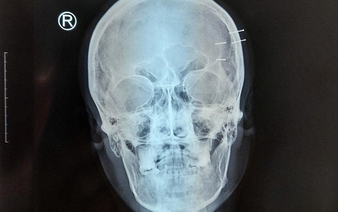 Man hospitalized with nails in head from self-harm in southern Vietnam