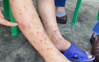 Fleas cause 160 allergic dermatitis cases in north-central Vietnam