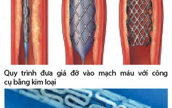 Nong động mạch vành bằng giá đỡ tự tiêu