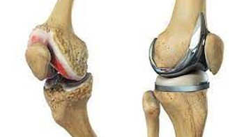 Thay khớp gối mới: chơi thể thao được không hay chỉ đi bộ chậm?