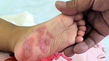 Trẻ hay đau nhức chân là bệnh gì?