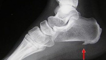 Phòng bệnh gai gót chân bằng cách nào?
