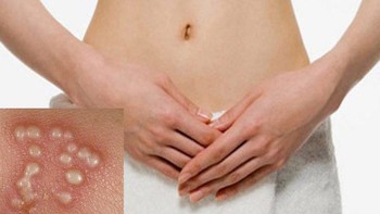 Chích vaccine ngừa Covid phải ngưng thuốc trị herpes sinh dục?