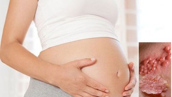 Bà bầu bị mụn rộp sinh dục thì phải sinh mổ?