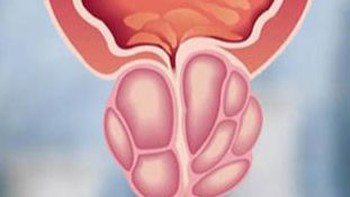 Đi ngoài phân dẹp mỏng, coi chừng dấu hiệu u xơ tiền liệt tuyến