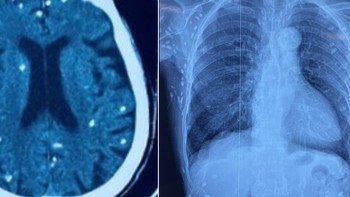 Rùng mình với hình ảnh nang sán dây lợn gây vôi hóa đầy cơ thể