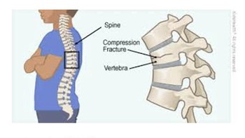 Loãng xương - căn bệnh bị xem nhẹ nhưng tỉ lệ tử vong cao
