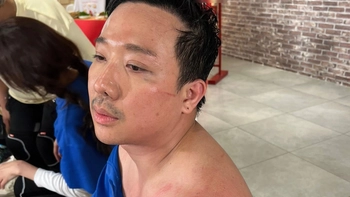 Trấn Thành bị thương tích đầy người: Ok! Không sao hết, Hai ổn!