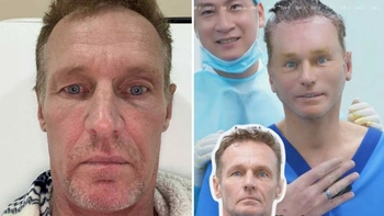 'Nổi như cồn' sau khi phẫu thuật thẩm mỹ ở Việt Nam