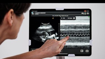 Mẹ bầu nên biết: Siêu âm tim thai giúp bác sĩ chuẩn bị gì cho bé sau sinh?