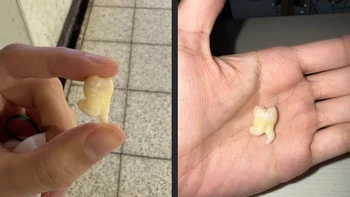 Ảnh vui 3-12: Chiếc răng khôn biết... nhảy chân sáo