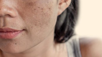 Vì sao da người Việt dễ sạm nám?