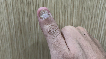 Trời nồm ẩm dễ mắc nấm da, nhận biết thế nào?