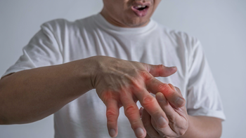 Bệnh gout dễ tái phát, lưu ý những dấu hiệu phải khám sớm